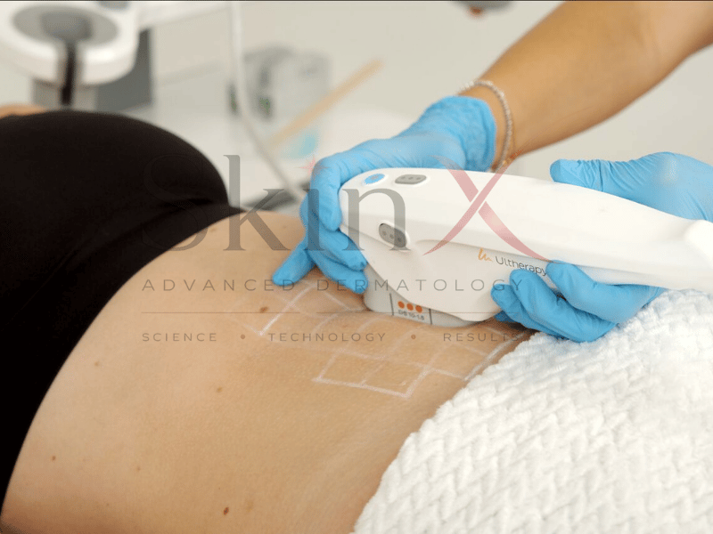 Ultherapy Prime trẻ hóa da sâu hơn, nhẹ nhàng hơn